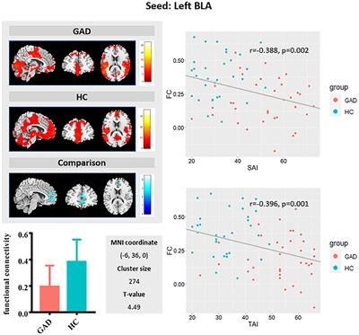 Dysfunction of Resting-State Functional Connectivity of Amygdala Subregions in Drug-Naïve Patients With Generalized Anxiety Disorder